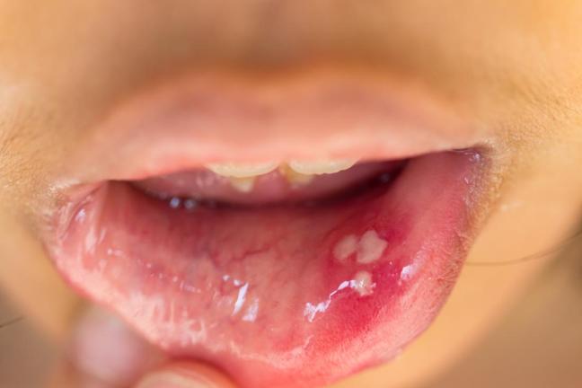 papillomavirus bocca lingua)
